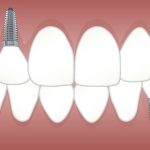 3 redenen waarom implantaten je leven verbeteren