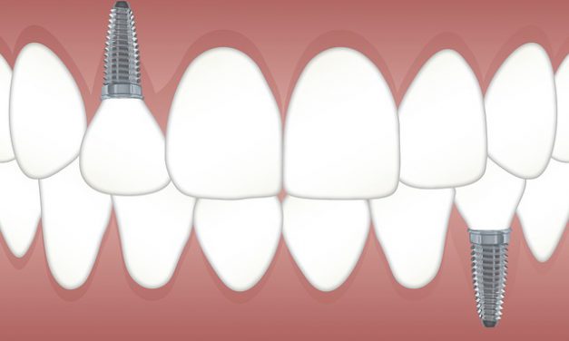 3 redenen waarom implantaten je leven verbeteren