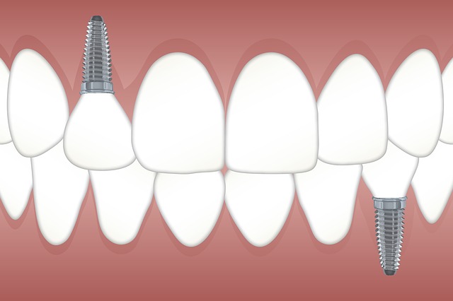 3 redenen waarom implantaten je leven verbeteren