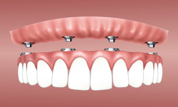 Wat doet een tandprotheticus?