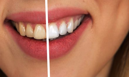 5 veel voorkomende gezondheidsklachten in en rond de mond