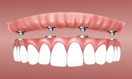 Nieuwe tanden in één dag – een nieuwe tandheelkundige techniek